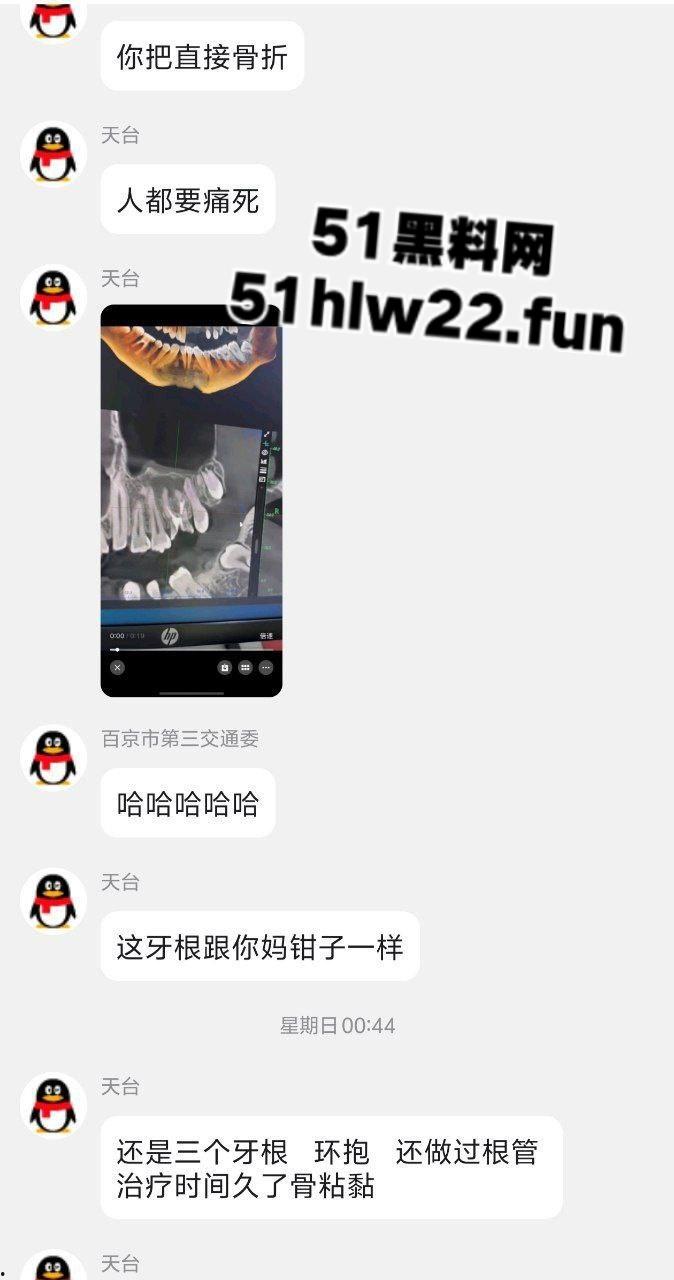 口腔医院逆天操作，客人拔智齿结果医生不分青红皂白直接大力出奇迹， 把上颌骨拔断撤了下来！